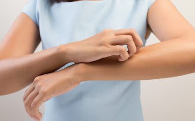 Picaduras de Mosquitos en Verano. CÃ³mo tratarlas y protegerse con homeopatÃ­a