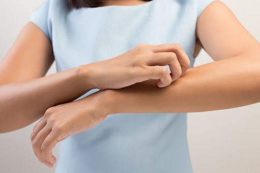 Picaduras de Mosquitos en Verano. CÃ³mo tratarlas y protegerse con homeopatÃ­a