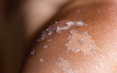 Remedios naturales para las quemaduras solares: Alivio y recuperación para tu piel