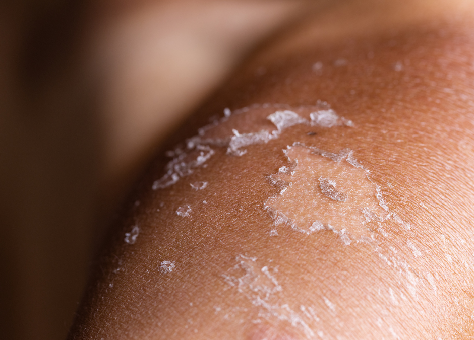 Remedios naturales para las quemaduras solares: Alivio y recuperación para tu piel