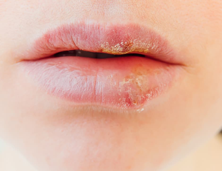 Calenturas en los labios: causas, tratamientos y prevención